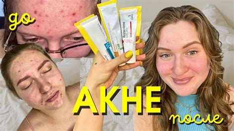 ТРИ ПРЕПАРАТА ОТ ПРЫЩЕЙ | Мой опыт лечения акне 💎 Средства, которые ...