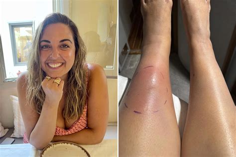 Woman develops lump in her leg—Can't believe what doctors discover