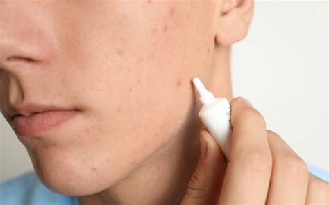 effective acne spot treatment  derm spot