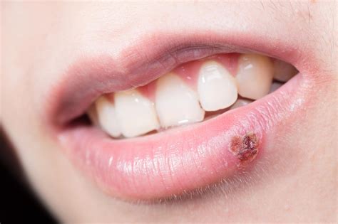 Herpes In Throat