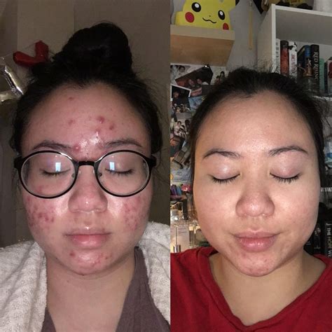 [Before&After] My Cystic Acne Journey! : r/SkincareAddiction