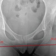 A 20-year-old woman with severe acetabular dysplasia. (a) Preoperative ...