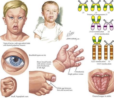 Trisomy Chromosome