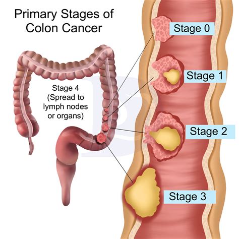 What is a tortuous colon and how does it affect digestion 18
