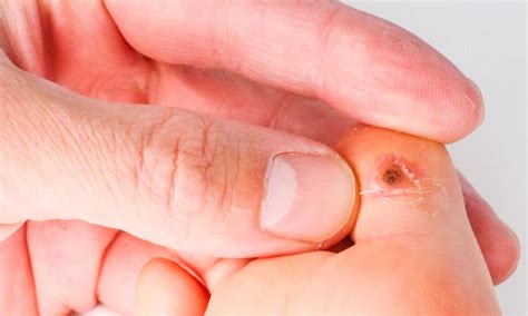 comprehensive  wart removal herald health