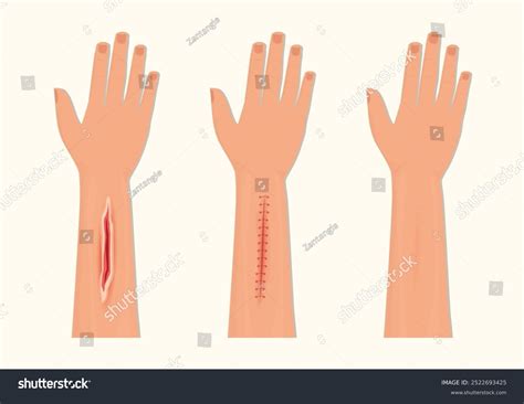 cutaneous wound   royalty  licensable stock illustrations
