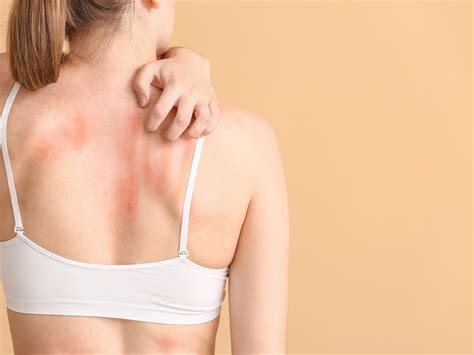 Allopurinol: Risiko für Hautreaktionen nicht bei jedem - PTA IN LOVE