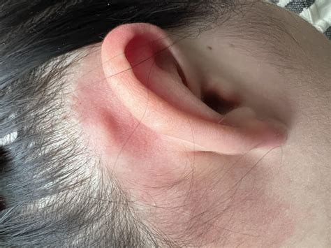 Why how to get rid of blackheads in ear is easier than you think 3