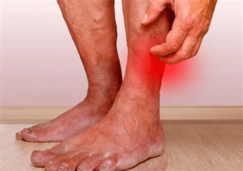 7 Ways to Accelerate Venous Ulcers Healing Process!