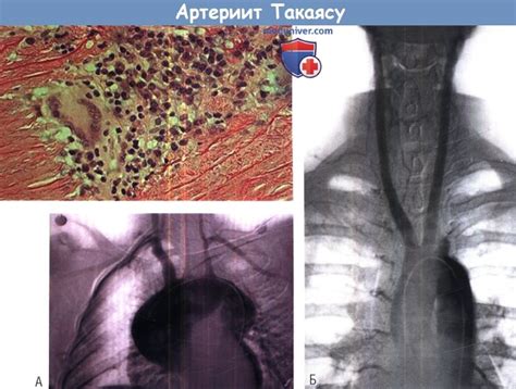 Артериит Такаясу (Takayasu): причины, диагностика, лечение