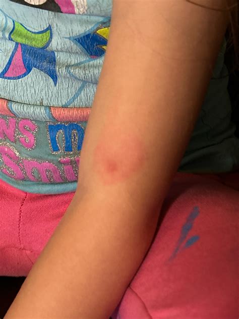 Brown Recluse bite? : r/spiderbites