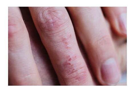 differential diagnosis distinguishing scabies   skin disorders