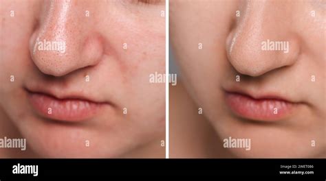 Blackhead treatment, before and after. Collage with photos of woman ...