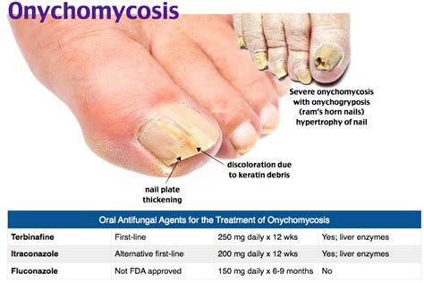 onychomyocosis - derm - | Onychomycosis, Pediatric nursing, Medical ...