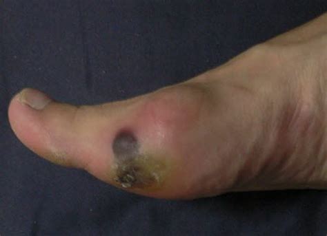 Blood Blister On Foot Best Sale | emergencydentistry.com