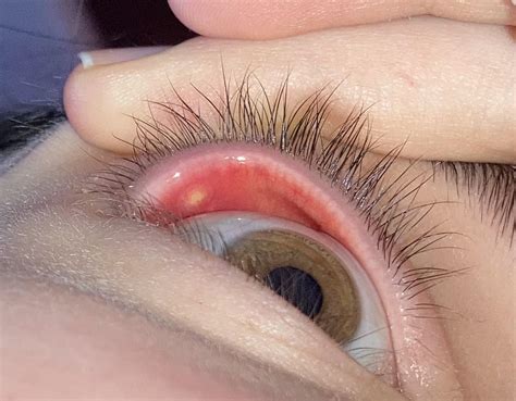 Internal Stye Upper Eyelid