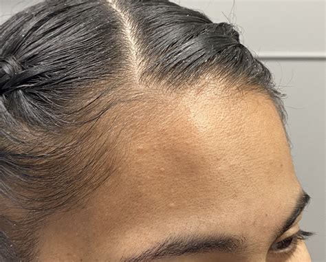 plastic surgery case study frontal hairline approach  upper
