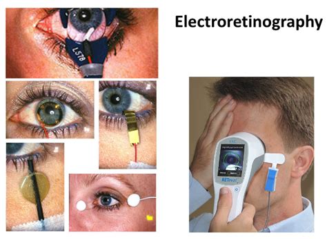 electroretinography explained slbgr