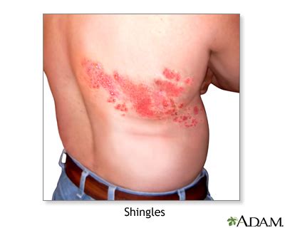 How bad are shingles? | O-T Lounge