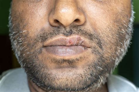 white spots   lips pictures reddit infoupdateorg
