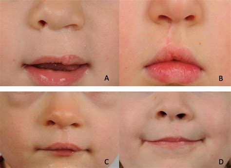 The role of scar massage in cleft lip surgery | Published in Australasian Journal of Plastic Surgery