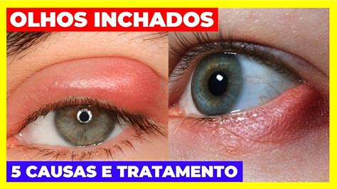 O Que E Bom Para Olho Inchado