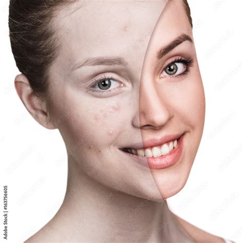 Girl with acne before and after treatment Stock Photo | Adobe Stock