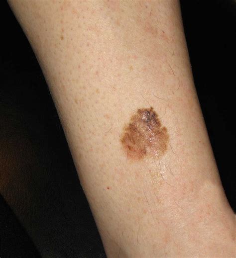 Melanoma Pictures