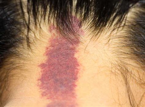 Port Wine Stains Birthmark | Laser Melbourne