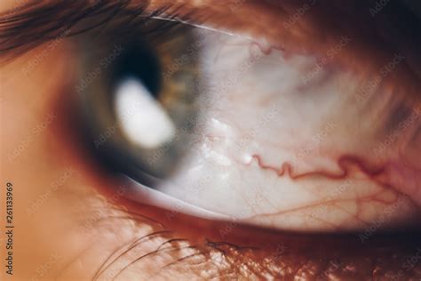macro eyes with bursting red blood vessels. eyeball covered with blood ...