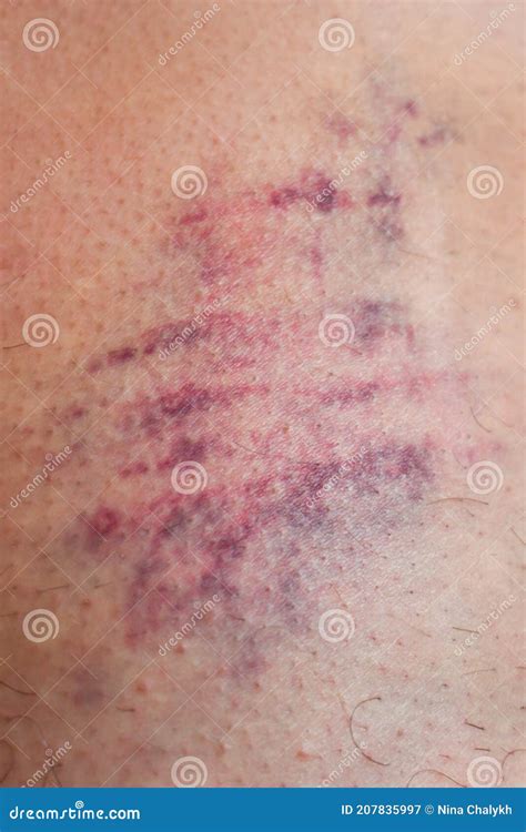 Huge Bruise On The Leg Of A Woman. A Bruised Leg. Close-up Stock Image ...