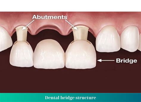 dental bridge   types  dental bridge nha khoa bedental