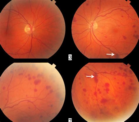 Ischemic Ocular Syndrome - Color Fundus Photographs - The Retina Reference