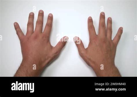comparison   male hands stung  bee  wasp hand swelling