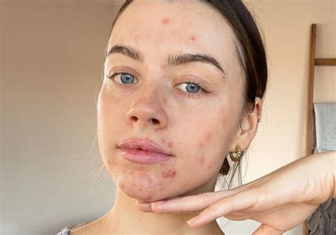 pinterest skin acne makeup girl  acne