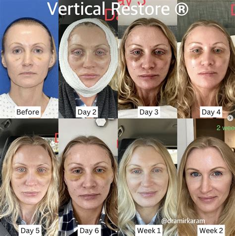 Vertical Restore Recovery Time San Diego | Dr. Karam | Facelift