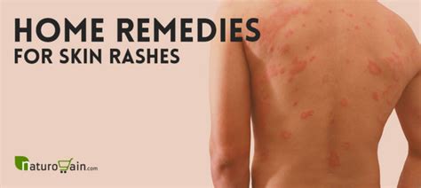 9 Home Remedies for Skin Rashes and Itching that Work [Naturally]