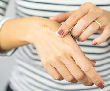 scars   types treatments prevention dermacare direct