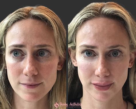 Unbelievable Blackhead Removal 2024: My Honest Review & Before/After Pics. Image 19