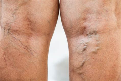 Why Do My Legs Feel Heavy? Key Causes