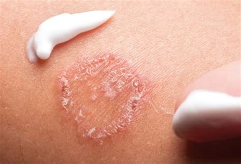 pictures  skin infections