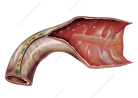 terminal ileum artwork stock image  science photo library