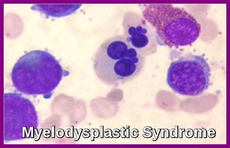 Myelodysplastic Syndrome - Ask Hematologist | Understand Hematology