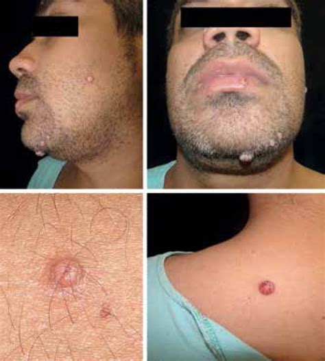 cryptococcuscryptococcosis concise medical knowledge
