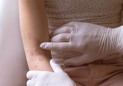 Most Common Skin Rashes Among Adults - Georgia Skin Cancer and Aesthetic Dermatology