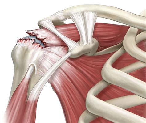 Rotator Cuff Repair — Surgical Rehab Specialists