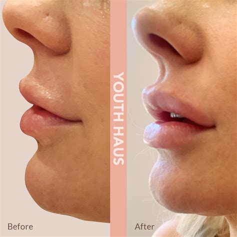 Collagen In Lips Before And After | Lipstutorial.org
