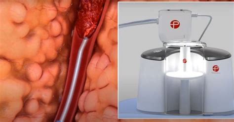 New Clot-Busting Procedure Saves Woman's Life | Mercy