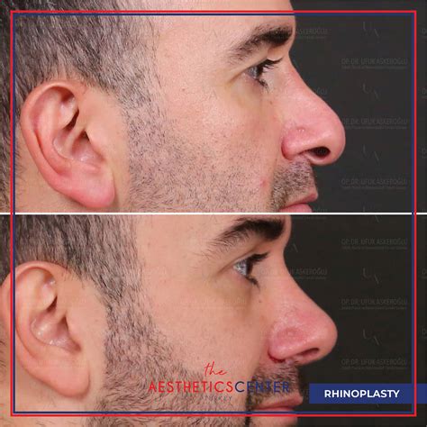 Rhinoplasty Turkey - Aesthetic Center Turkey