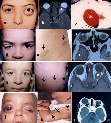 Neurogenic lesions: Optic nerve glioma. (a) A clinical photograph of a... | Download Scientific ...